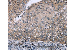 Immunohistochemistry of Human cervical cancer using RNF144B Polyclonal Antibody at dilution of 1:50 (RNF144B 抗体)