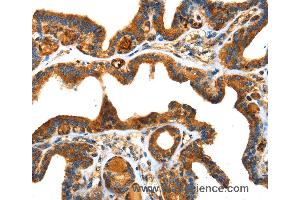 Immunohistochemistry of Human thyroid cancer using SPARC Polyclonal Antibody at dilution of 1:25 (SPARC 抗体)