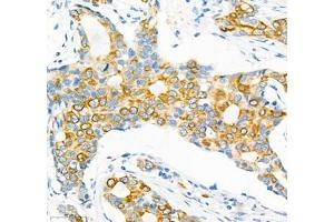 Immunohistochemistry of paraffin embedded human breast cancer using Epl4 (ABIN7073843) at dilution of 1:2000 (400x lens) (EFNA4 抗体)