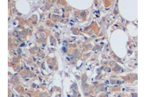 Detection of CA125 in Human Breast cancer Tissue using Polyclonal Antibody to Carbohydrate Antigen 125 (CA125) (MUC16 抗体  (AA 13977-14117))