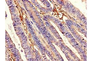 Immunohistochemistry of paraffin-embedded human colon cancer using ABIN7151326 at dilution of 1:100 (EEA1 抗体  (AA 734-875))