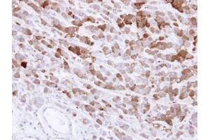 IHC-P Image Immunohistochemical analysis of paraffin-embedded MDA-MB-468 xenograft , using AKR1C1, antibody at 1:500 dilution. (AKR1C1 抗体)