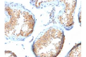 Formalin-fixed, paraffin-embedded human Testicular Carcinoma stained with Vinculin Mouse Monoclonal Antibody (VCL/2573). (Vinculin 抗体  (AA 174-322))