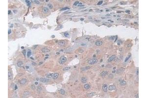 Detection of ASAH1 in Human Breast cancer Tissue using Polyclonal Antibody to N-Acylsphingosine Amidohydrolase 1 (ASAH1) (ASAH1 抗体  (AA 144-395))