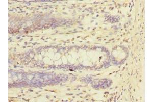 Immunohistochemistry of paraffin-embedded human colon cancer using ABIN7151244 at dilution of 1:100 (TRIM17 / RNF16 抗体  (AA 1-300))