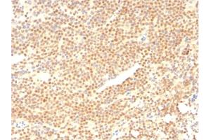 Formalin-fixed, paraffin-embedded human Mantle Cell Lymphoma stained with Cyclin D1 Mouse Monoclonal Antibody (CCND1/2593). (Cyclin D1 抗体)