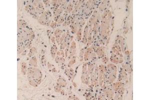 IHC-P analysis of Human Esophagus Cancer Tissue, with DAB staining. (Caspase 3 抗体  (AA 29-175))