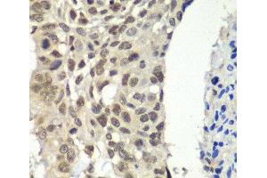 Immunohistochemistry of paraffin-embedded Human esophageal cancer using SSRP1 Polyclonal Antibody at dilution of 1:100 (40x lens). (SSRP1 抗体)