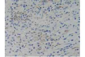 IHC-P analysis of Human Prostate Gland Cancer Tissue, with DAB staining. (WARS 抗体  (AA 247-458))