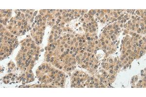 Immunohistochemistry of paraffin-embedded Human liver cancer tissue using SOCS7 Polyclonal Antibody at dilution 1:30 (SOCS7 抗体)