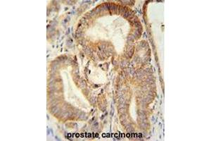 CLDN7 antibody (C-term) immunohistochemistry analysis in formalin fixed and paraffin embedded human prostate carcinoma followed by peroxidase conjugation of the secondary antibody and DAB staining. (Claudin 7 抗体  (C-Term))