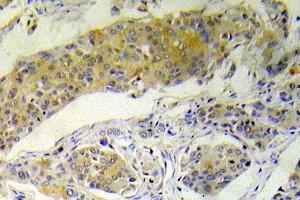Immunohistochemistry (IHC) analyzes of p-BAD antibody in paraffin embedded human breast carcinoma tissue. (BAD 抗体  (pSer112))