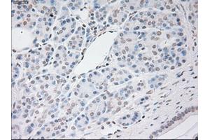 Immunohistochemical staining of paraffin-embedded Adenocarcinoma of breast tissue using anti-VEGF mouse monoclonal antibody. (VEGF 抗体  (AA 27-233))