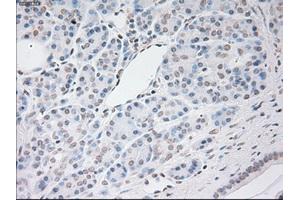 Immunohistochemical staining of paraffin-embedded Adenocarcinoma of breast tissue using anti-VEGF mouse monoclonal antibody.
