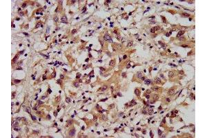 IHC image of ABIN7143473 diluted at 1:300 and staining in paraffin-embedded human liver cancer performed on a Leica BondTM system. (ARL1 抗体  (AA 2-181))