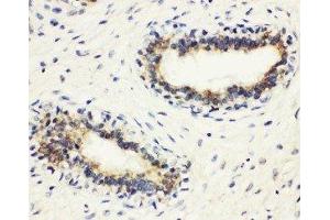 Anti-HLA DMB antibody, IHC(P) IHC(P): Human Mammary Cancer Tissue (HLA-DMB 抗体  (Middle Region))