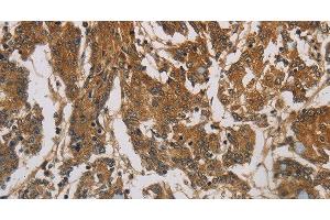 Immunohistochemistry of paraffin-embedded Human colon cancer using CORO1C Polyclonal Antibody at dilution of 1:60 (CORO1C 抗体)