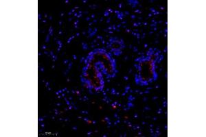 Immunofluorescence of paraffin embedded human breast cancer using NCK (ABIN7074783) at dilution of 1:1000 (250x lens) (NCK2 抗体)