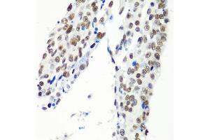 Immunohistochemistry of paraffin-embedded human lung cancer using HTATSF1 antibody (ABIN5973562) at dilution of 1/100 (40x lens). (HTATSF1 抗体)