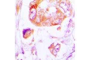 Immunohistochemical analysis of CK1 alpha staining in human lung cancer formalin fixed paraffin embedded tissue section. (CSNK1A1 抗体  (Center))