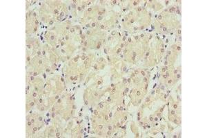 Immunohistochemistry of paraffin-embedded human gastric cancer using ABIN7151953 at dilution of 1:100 (Eppin 抗体  (AA 22-133))