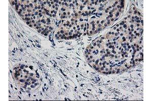 Immunohistochemical staining of paraffin-embedded Carcinoma of Human pancreas tissue using anti-TMOD1 mouse monoclonal antibody. (Tropomodulin 1 抗体)