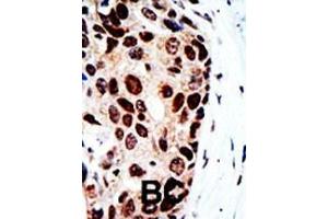 Formalin-fixed and paraffin-embedded human cancer tissue reacted with the primary antibody, which was peroxidase-conjugated to the secondary antibody, followed by DAB staining. (HDAC9 抗体  (C-Term))