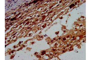 IHC image of ABIN7145615 diluted at 1:400 and staining in paraffin-embedded human melanoma performed on a Leica BondTM system. (BTD 抗体  (AA 322-397))