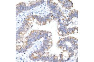 Immunohistochemistry of paraffin-embedded human colon carcinoma using ACADS / SCAD Rabbit mAb (ABIN7265419) at dilution of 1:50 (40x lens). (ACADS 抗体)