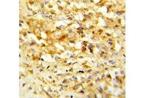 IHC analysis of FFPE human prostate carcinoma stained with NKX3. (NKX3-1 抗体  (AA 118-145))