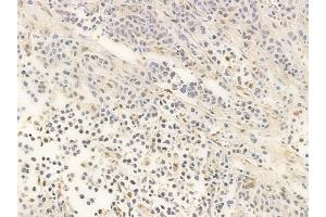 ABIN6266072 and ABIN6266816 at 1/100 staining human non-Hodgkin lymphoma by IHC-P.