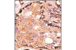 Formalin-fixed and paraffin-embedded human cancer tissue reacted with the primary antibody, which was peroxidase-conjugated to the secondary antibody, followed by AEC staining. (DUSP4 抗体  (C-Term))