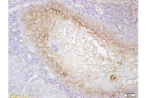 Formalin-fixed and paraffin embedded human laryngeal cancer labeled with Anti-MCSF ReceptorPolyclonal Antibody, Unconjugated (ABIN750143) at 1:200 followed by conjugation to the secondary antibody and DAB staining