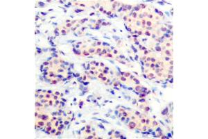Immunohistochemical analysis of paraffin-embedded human breast carcinoma tissue using JunD (Ab-255) antibody (#B7137). (JunD 抗体  (Ser255))