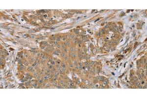 Immunohistochemistry of paraffin-embedded Human cervical cancer tissue using RNF148 Polyclonal Antibody at dilution 1:45 (RNF148 抗体)