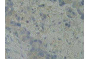 IHC-P analysis of Human Breast Cancer Tissue, with DAB staining. (BMX 抗体  (AA 287-523))
