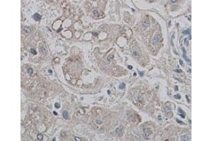 Immunohistochemical staining of formalin-fixed paraffin-embedded human liver tissue showing membrane staining with AQP9 polyclonal antibody  at 1 : 100 dilution. (AQP9 抗体  (N-Term))