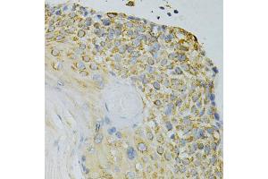 Immunohistochemistry of paraffin-embedded human esophageal cancer using GPX4 Antibody (ABIN5970997) at dilution of 1/200 (40x lens). (GPX4 抗体)