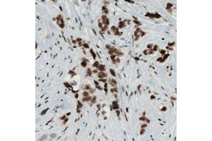 Immunohistochemical staining (Formalin-fixed paraffin-embedded sections) of human breast cancer with KDM5B monoclonal antibody, clone CL1129  shows strong nuclear immunoreactivity in tumor cells.