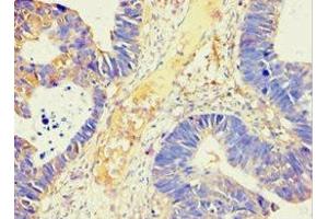 Immunohistochemistry of paraffin-embedded human ovarian cancer using ABIN7143846 at dilution of 1:100 (AMY2B 抗体  (AA 16-320))