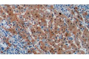 Detection of ARG in Human Liver cancer Tissue using Monoclonal Antibody to Arginase (ARG) (ARG 抗体  (AA 1-322))