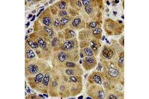 Immunohistochemical analysis of Centrin-1 staining in human liver cancer formalin fixed paraffin embedded tissue section. (Centrin 1 抗体)