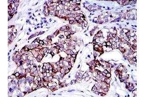 Immunohistochemical analysis of paraffin-embedded human bladder cancer tissues using KRT19 mouse mAb with DAB staining. (Cytokeratin 19 抗体)