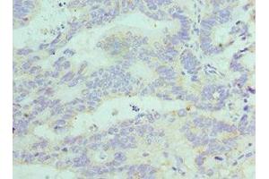 Immunohistochemistry of paraffin-embedded human colon cancer using ABIN7152772 at dilution of 1:100 (FGF1 抗体  (AA 16-155))