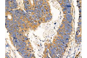 ABIN6259147 and ABIN6274943 at 1/100 staining Human colorectal cancer by IHC-P. (PDE4C 抗体  (Internal Region))