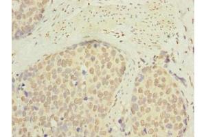 Immunohistochemistry of paraffin-embedded human gastric cancer using ABIN7145334 at dilution of 1:100