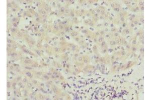 Immunohistochemistry of paraffin-embedded human liver cancer using ABIN7146346 at dilution of 1:100 (CALCOCO1 抗体  (AA 462-691))