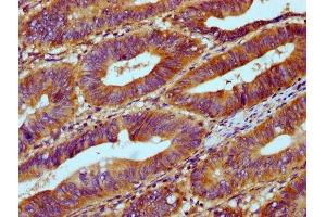 IHC image of ABIN7168103 diluted at 1:300 and staining in paraffin-embedded human colon cancer performed on a Leica BondTM system. (Ribonuclease H1 抗体  (AA 73-185))