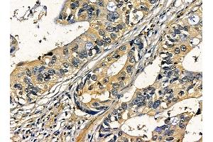 ABIN7095313 and ABIN7099370 at 1/100 staining human pancreatic cancer by IHC-P. (C2CD2 抗体)