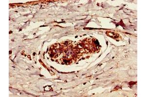 Immunohistochemistry of paraffin-embedded human breast cancer using ABIN7174362 at dilution of 1:100 (CYLD 抗体  (C-Term))